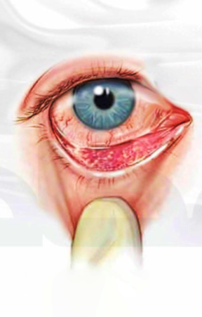 How to capture conjunctiva